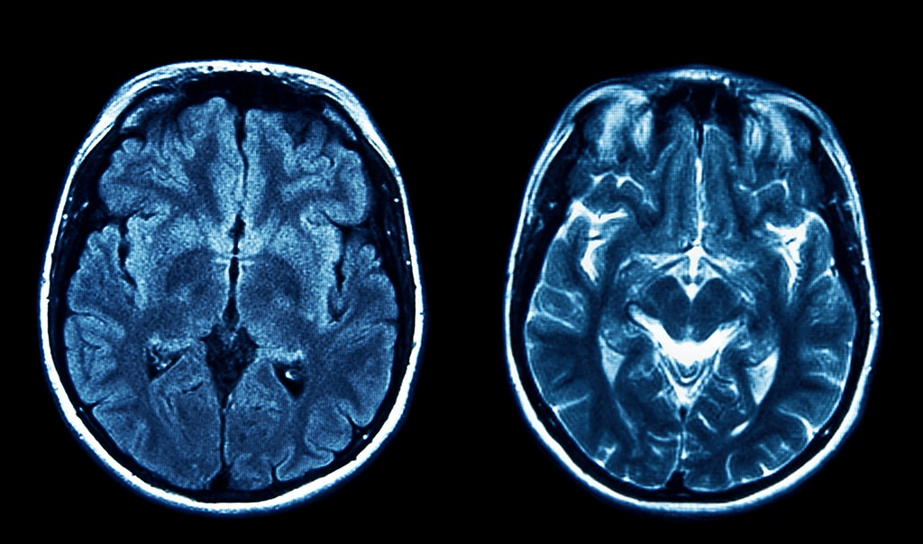 Brain Tumor Classification